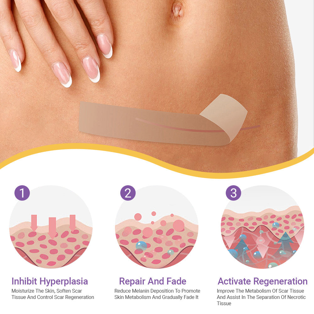 ✅Official Store | BBOJI® Hyaluronan Nano Microneedle Repair Tape🏥(Treatment of old and new scars, reduction of surgical scars, stretch marks, keloids, acne, burns, warts, dermatomes and varicose veins)★
