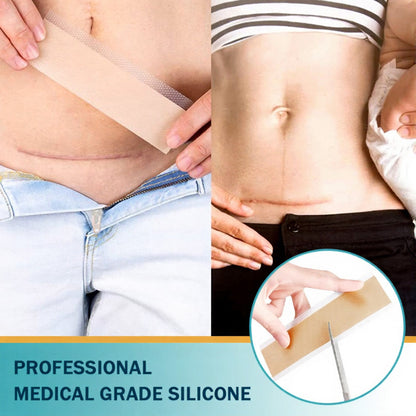 🍍Official Store |Cheemex® Hyaluronic Acid Nano Microneedle Repair Tape🗽🎉(Treatment of old and new scars, reduction of surgical scars, stretch marks, keloids, acne, burns, warts, dermatomes and varicose veins)