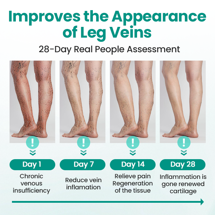 Erase Varicose Veins and Leg Pain Fast—Glowrizon® LegRenew Patch with 80% Off Today Only!
