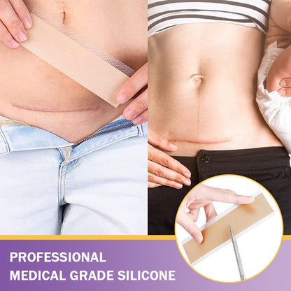 ✅Official Store | BBOJI® Hyaluronan Nano Microneedle Repair Tape🏥(Treatment of old and new scars, reduction of surgical scars, stretch marks, keloids, acne, burns, warts, dermatomes and varicose veins)★